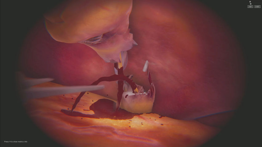SurgicaVR