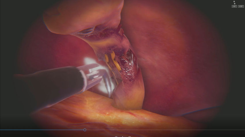 SurgicaVR