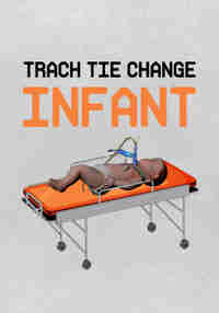 Trach Tie Change – Infant