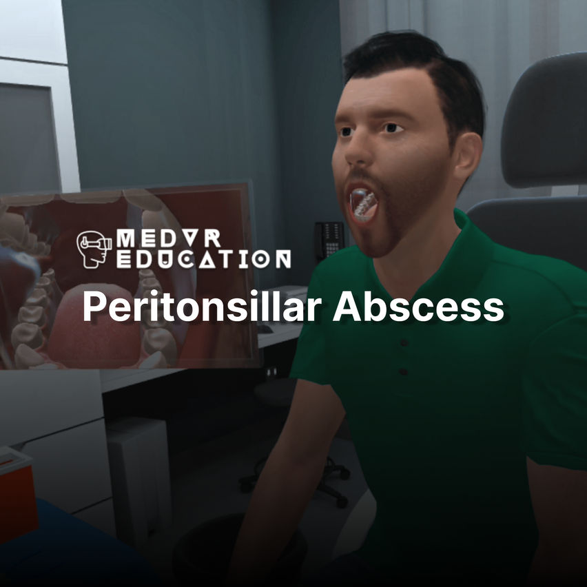 Peritonsillar Abscess Needle Aspiration