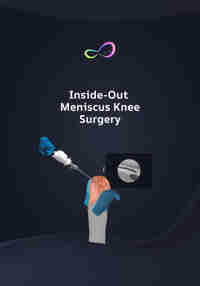 Meniscus Repair Inside Out
