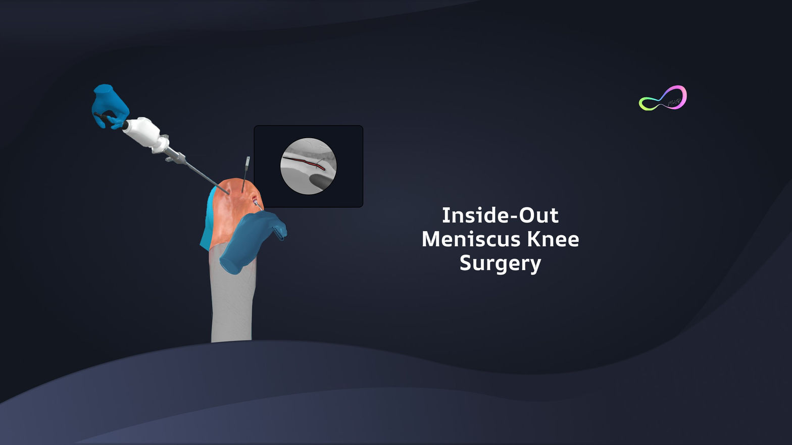 Meniscus Repair Inside Out