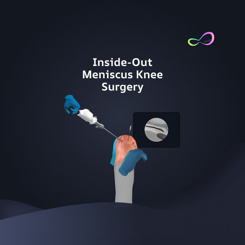 Meniscus Repair Inside Out