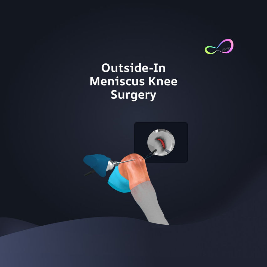 Meniscus Repair Outside In