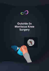 Meniscus Repair Outside In