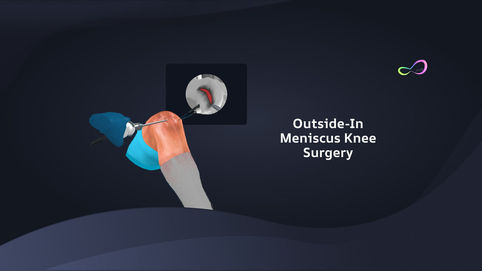 Meniscus Repair Outside In