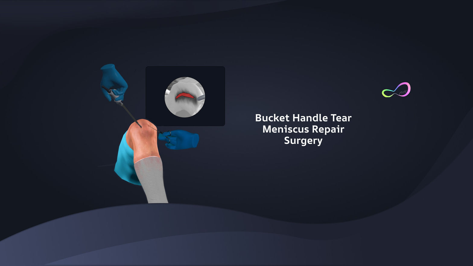 Bucket Handle Meniscus Tear Surgery