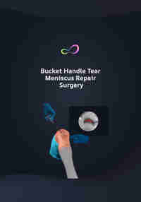 Bucket Handle Meniscus Tear Surgery