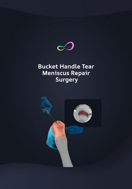 Bucket Handle Meniscus Tear Surgery
