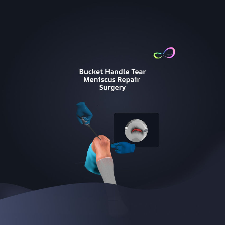 Bucket Handle Meniscus Tear Surgery