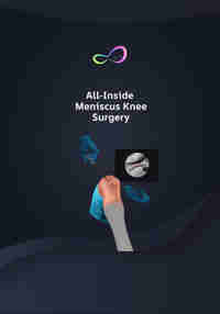 All Inside Meniscus Repair Surgery