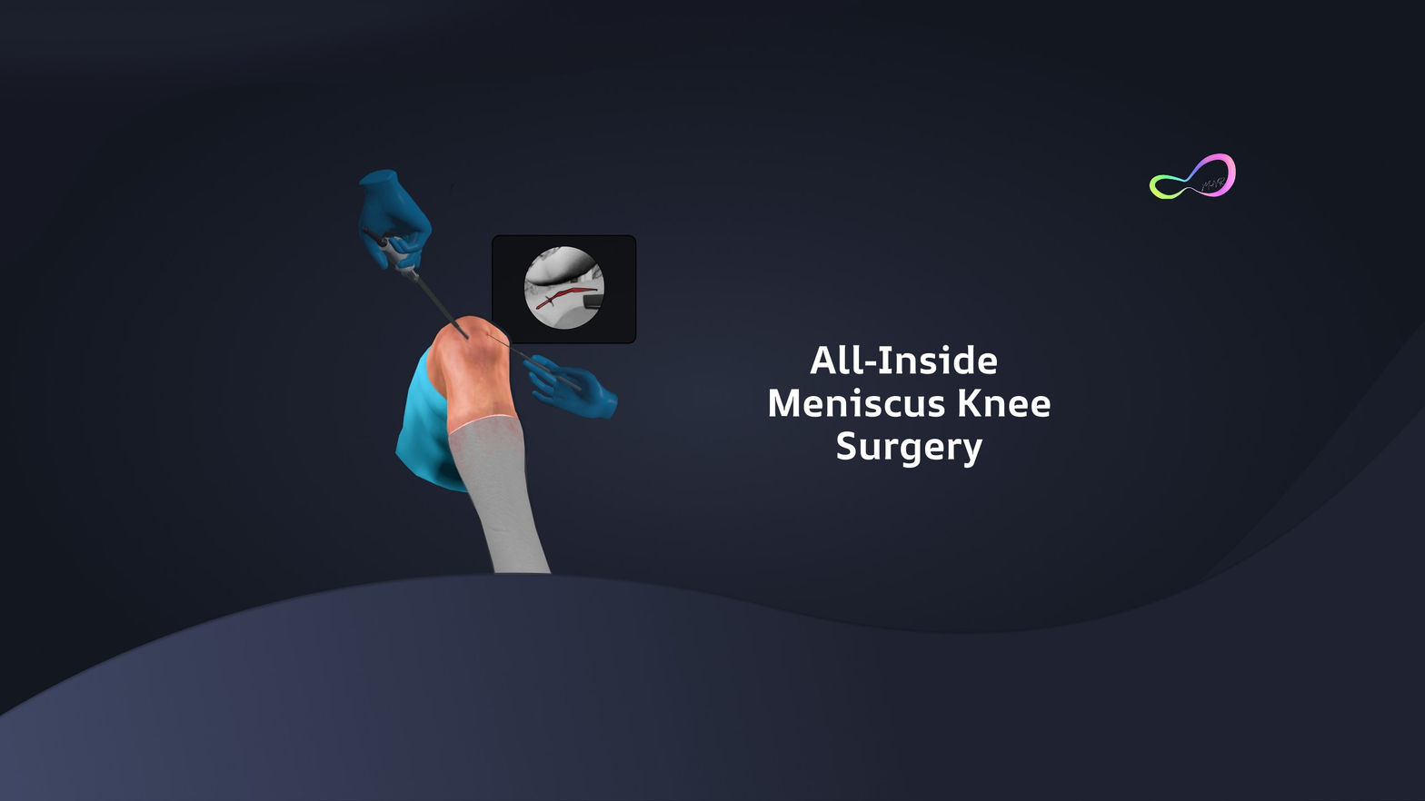 All Inside Meniscus Repair Surgery