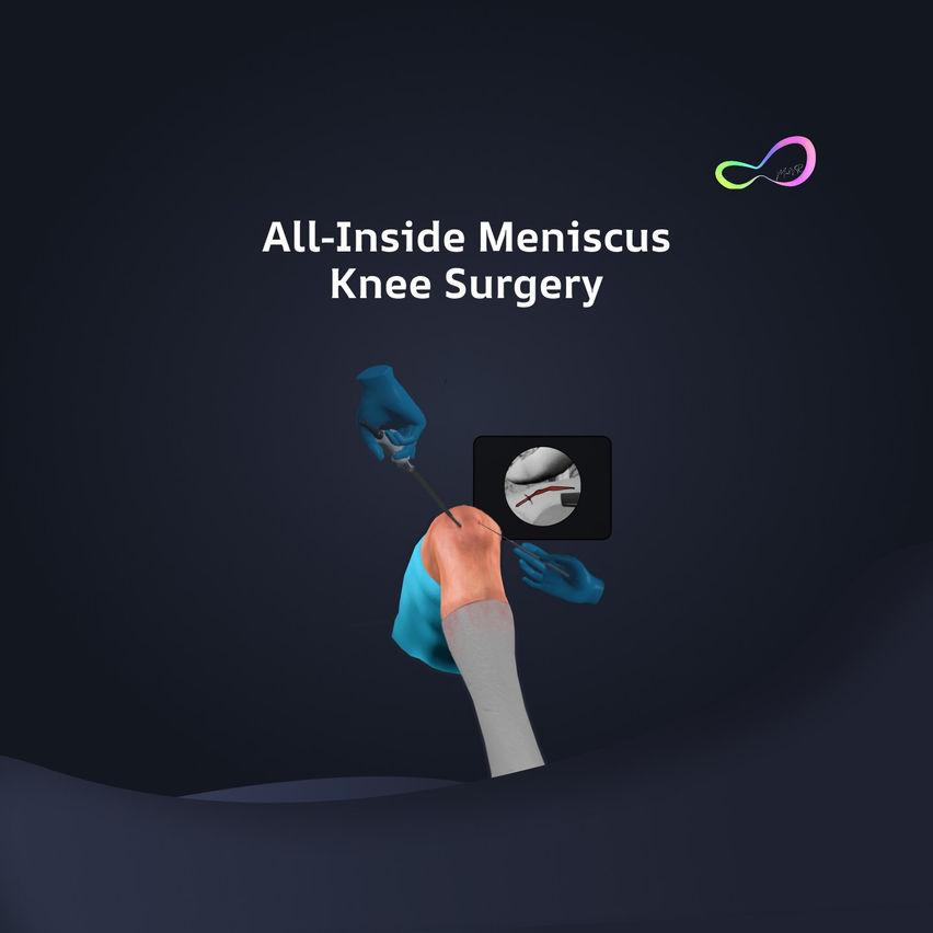 All Inside Meniscus Repair Surgery