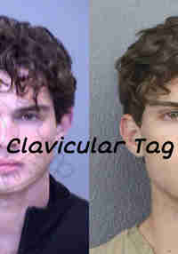 Clavicular Tag