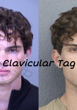 Clavicular Tag